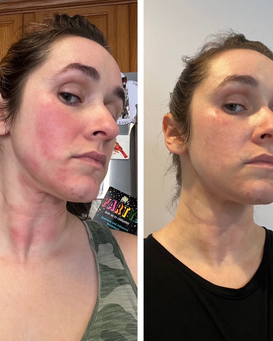 Cosmetic treatment comparison collage showing facial skin