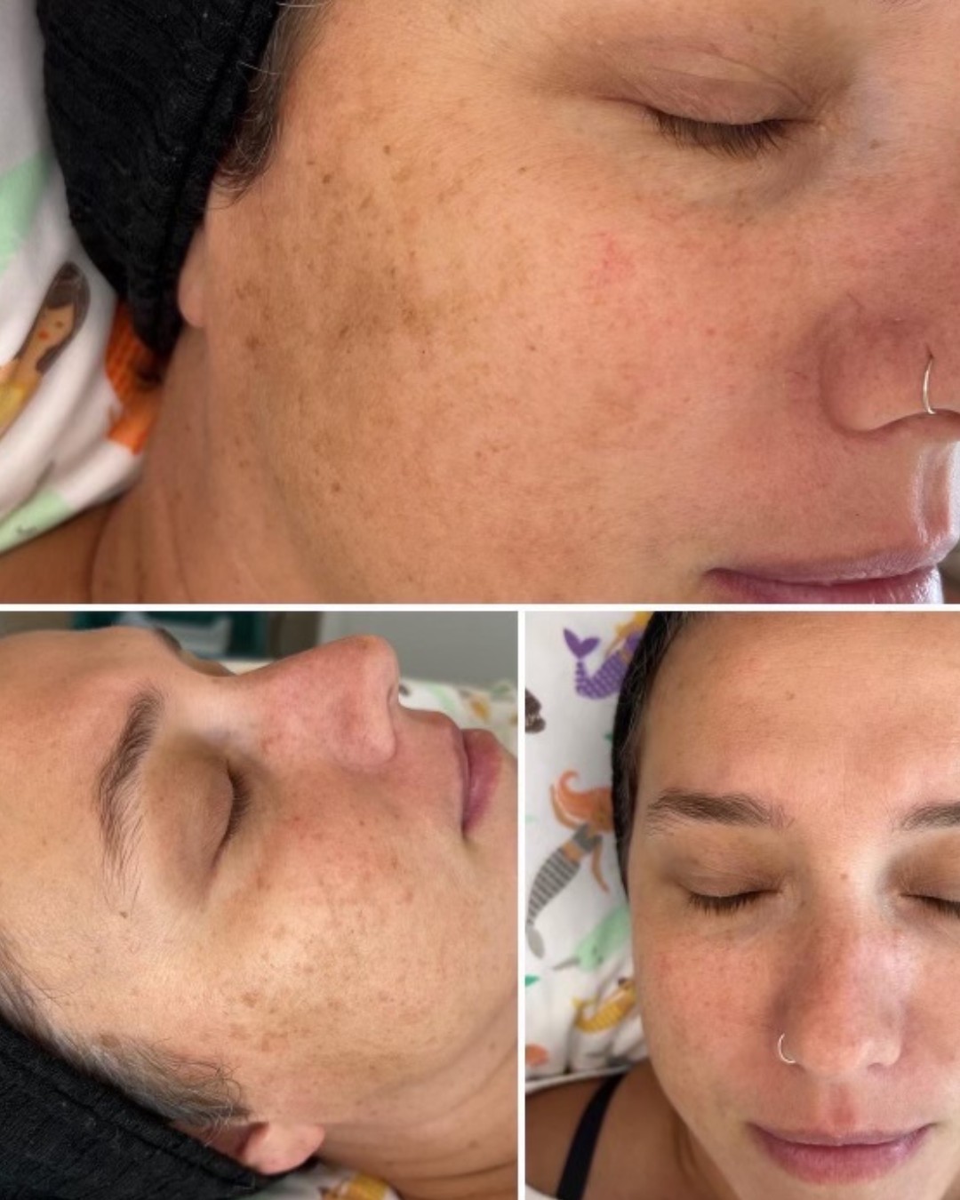 Cosmetic treatment comparison collage showing facial skin