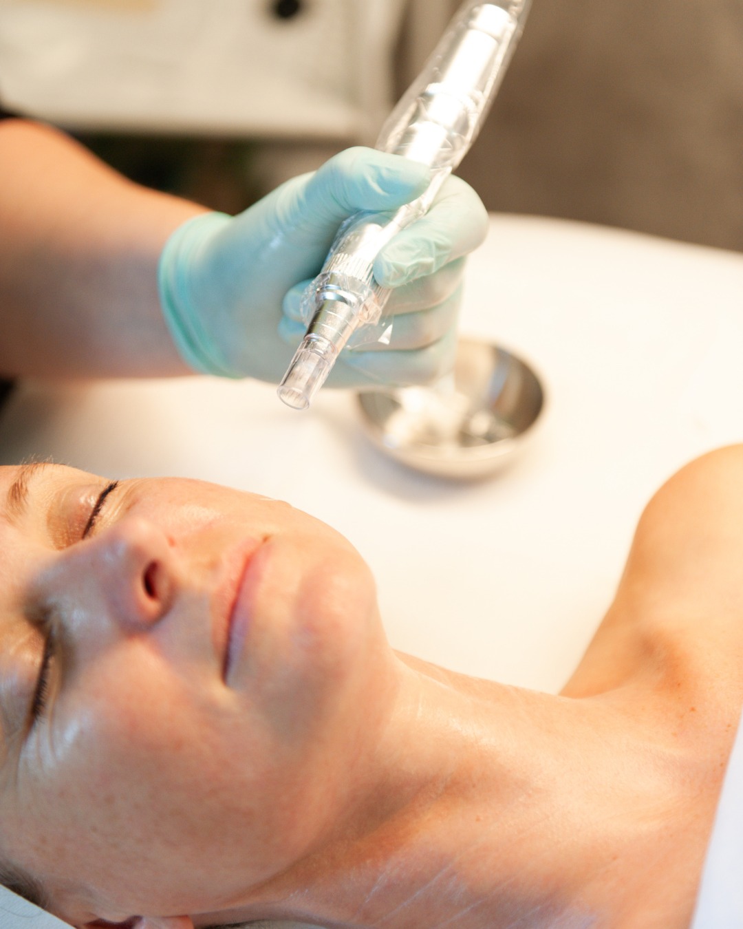 Microneedling treatment with a sterile pen